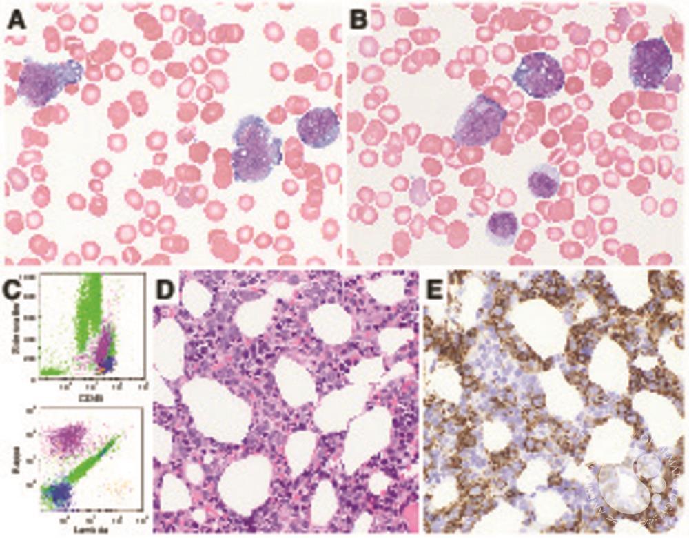 Leukemic presentation of diffuse large B-cell lymphoma: an unusual pattern associated with splenic involvement