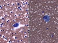 Megakaryocytes in the bone marrow of a newborn with Congenital Amegakaryocytic Thrombocytopenia (CAMT)