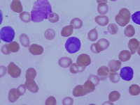 AML with cup-like nuclear invaginations