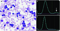 Interference of hyperleukocytosis in red blood cell count