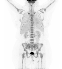 PET scan of the patient