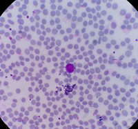 Microcytic RBCs with lymphocyte for comparison 1