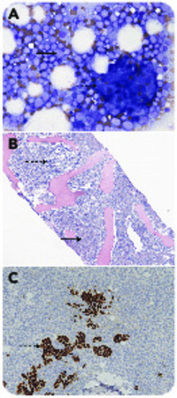 Myelophthisic marrow involved by breast cancer and acute myeloid leukemia