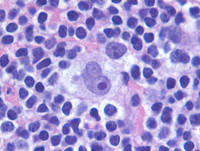 HL - Lacunar HRS cells