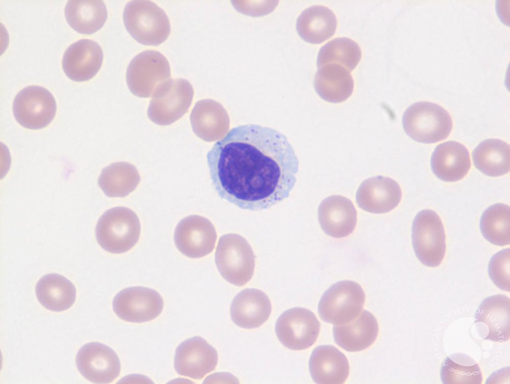 Monomorphic PTLD: T large granular lymphocytic leukemia 