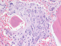 Marrow Neuroblastoma