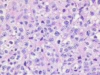 Primary Mediastinal B-cell Lymphoma