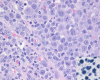 Plasmablastic Lymphoma