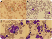 Differential diagnosis of myelodysplastic syndrome: anemia associated with copper deficiency