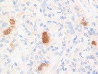 PAX5 immunostain