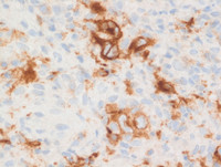 CD30 immunostain