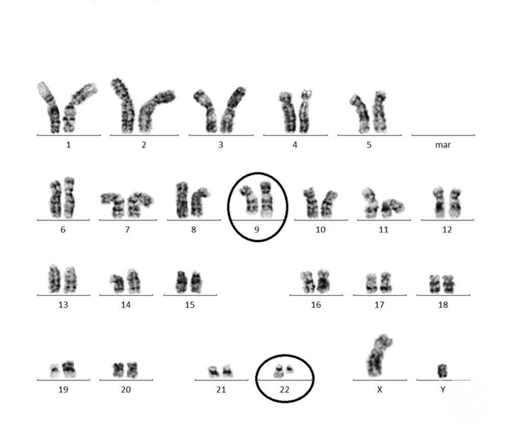 Philadelphia Chromosome by karyotype