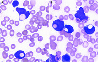 Frequent erythrophagocytosis by leukemic blasts in B-cell acute lymphoblastic leukemia