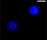 Atypical FISH signal pattern in APL (Acute Promyelocytic Leukemia)