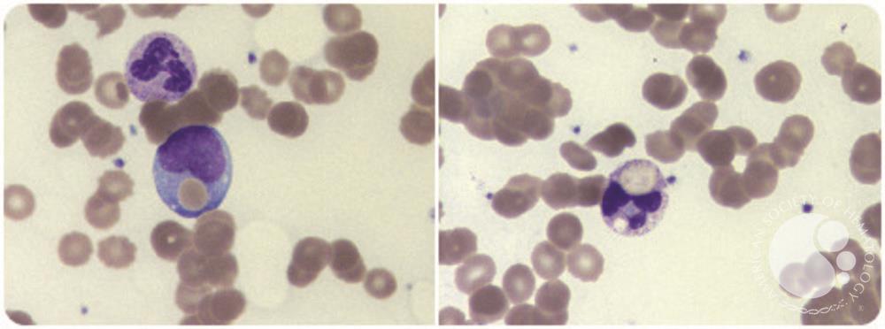 Paroxysmal cold hemoglobinuria with acute renal failure