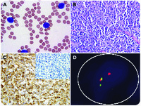 Extramedullary relapse of KMT2A(MLL)-rearranged acute lymphoblastic leukemia with lineage switch following blinatumomab