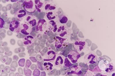 Falciparum-Pigments-laden neutrophils
