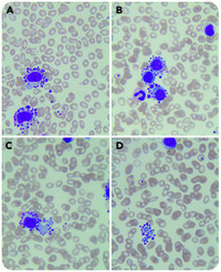 Platelet satellitism around cytoplasmic fragments of neoplastic lymphocytes