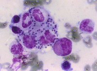 Hemophagocytic lymphohistiocytosis with LD bodies