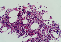 Immune thrombocytopenic purpura (ITP) bone marrow biopsy view 1