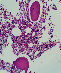 Immune thrombocytopenic purpura (ITP) bone marrow biopsy view 6