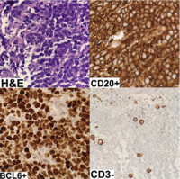 Hepatic Large B-cell Lymphoma
