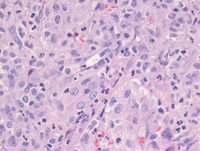 Myeloid Sarcoma 1