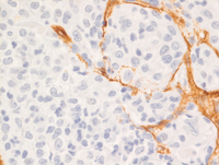 Myeloid Sarcoma 2