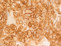 Myeloid Sarcoma 3