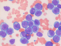 Acute Monoblastic Leukemia