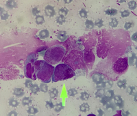 Acute promyelocytic leukaemia with t(15;17) 2