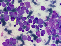 Acute promyelocytic leukaemia with t(15;17) 3