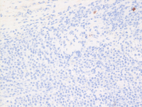 EBV+Plasmablastic lymphoma-CD20