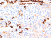 EBV+Plasmablastic lymphoma-CD45
