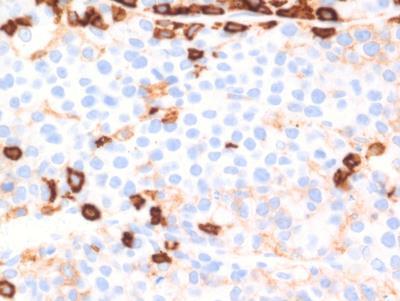 EBV+Plasmablastic lymphoma-CD45