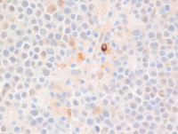 EBV+Plasmablastic lymphoma-CD79a
