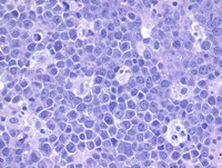 EBV+Plasmablastic lymphoma-HE