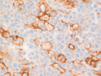 EBV+Plasmablastic lymphoma-PD-L1