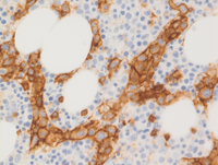 Intravascular-DLBCLCD20