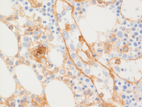 Intravascular-DLBCLCD31