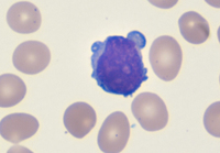 T-Prolymphocytic leukemia