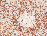 Lymphomatoid-granulomatosisCD3