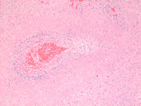 Lymphomatoid-granulomatosis