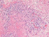 Lymphomatoid granulomatosis-HE