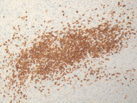 Splenic marginal zone lymphoma