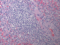 Splenic marginal zone lymphoma-HE