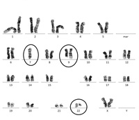 High hypodiploid karyotype showing t(9;22)(q34;q11.2) along with monosomy 7 in adult ALL
