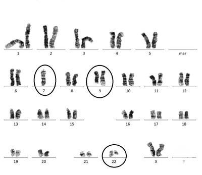 High hypodiploid karyotype showing t(9;22)(q34;q11.2) along with monosomy 7 in adult ALL