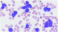 Cuplike nuclear morphology in pediatric B-cell acute lymphoblastic leukemia