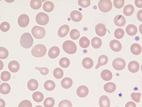 Blood-Tear Drop cells